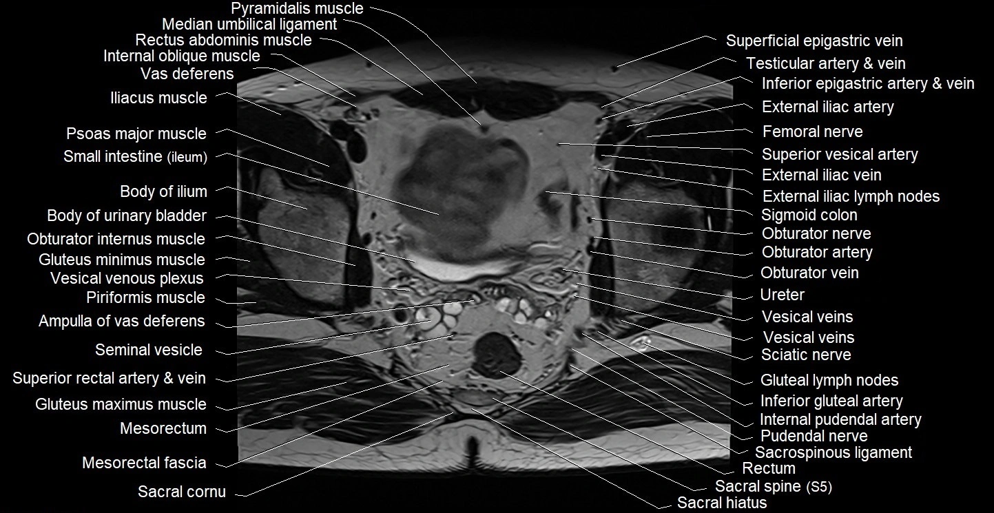 Male pelvis axial cross sectional anatomy image 22.webp